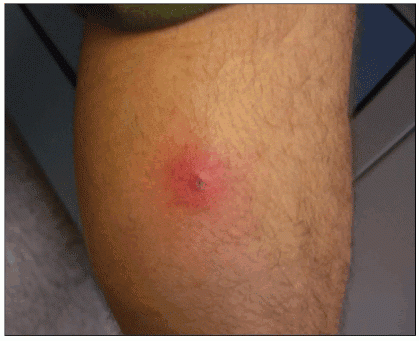 MRSA Infection Pictures, Treatment, and Symptoms