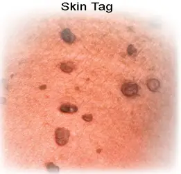 skin tag example